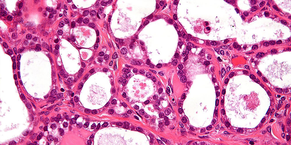 Ovarian Cancer cells